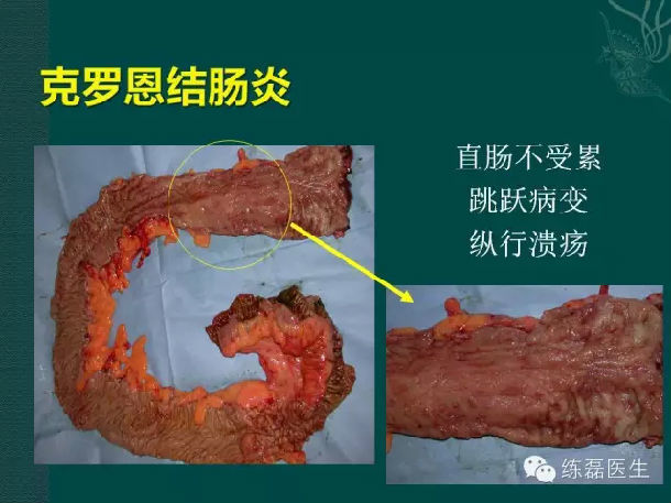 罗克恩是什么病_罗克罗恩病_克罗恩疾病能治好吗