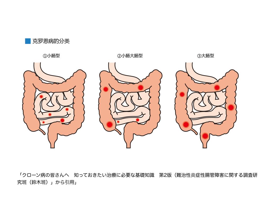 罗克恩病能治好吗_l克罗恩_克罗恩能活多久