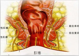 低位肛瘘切除术术后疼吗_低位肛瘘手术肛门失禁_低位肛门手术失禁肛瘘图片