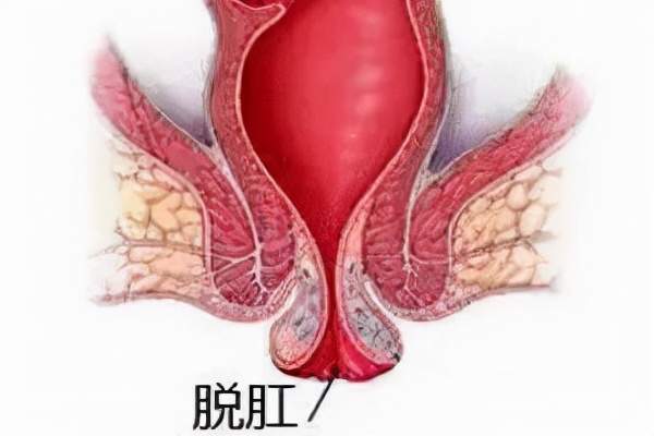 低位肛门手术失禁肛瘘图片_低位肛瘘手术肛门失禁_低位肛瘘切除术术后疼吗