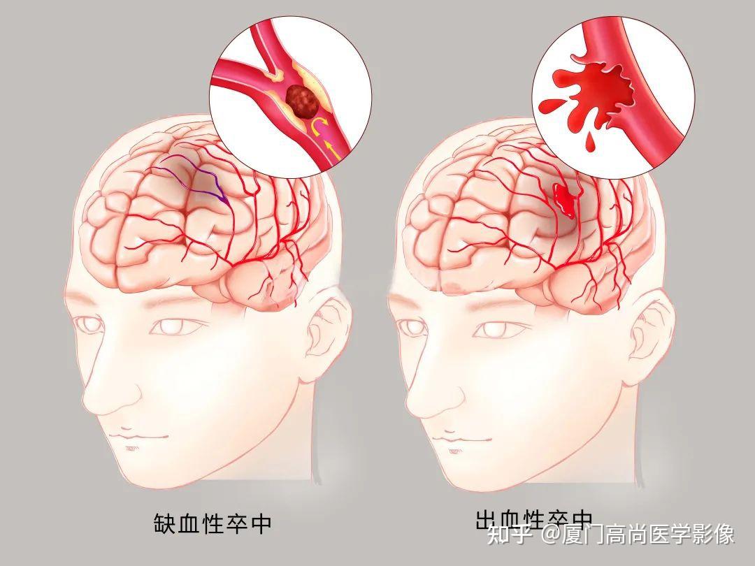 进展性卒中怎么治_进展性卒中治疗_进展性卒中治疗指南