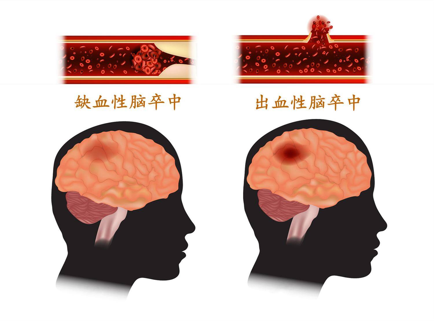 进展性卒中怎么治_进展性卒中治疗指南_进展性卒中治疗