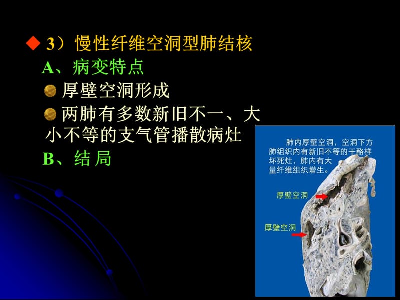 继发性肺结核会复发吗_肺结核性继发复发会传染人吗_肺结核复发还有传染性吗