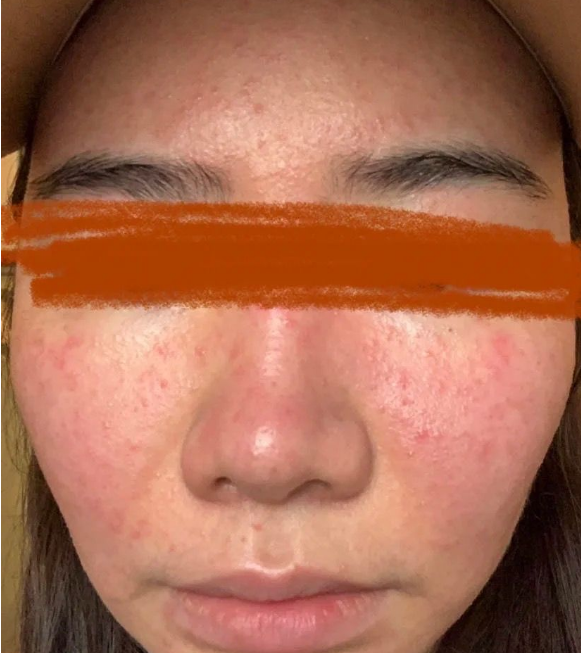 脸部脱皮痒是怎么回事_脸部脱皮发痒怎么办_脸部发痒脱皮怎么办