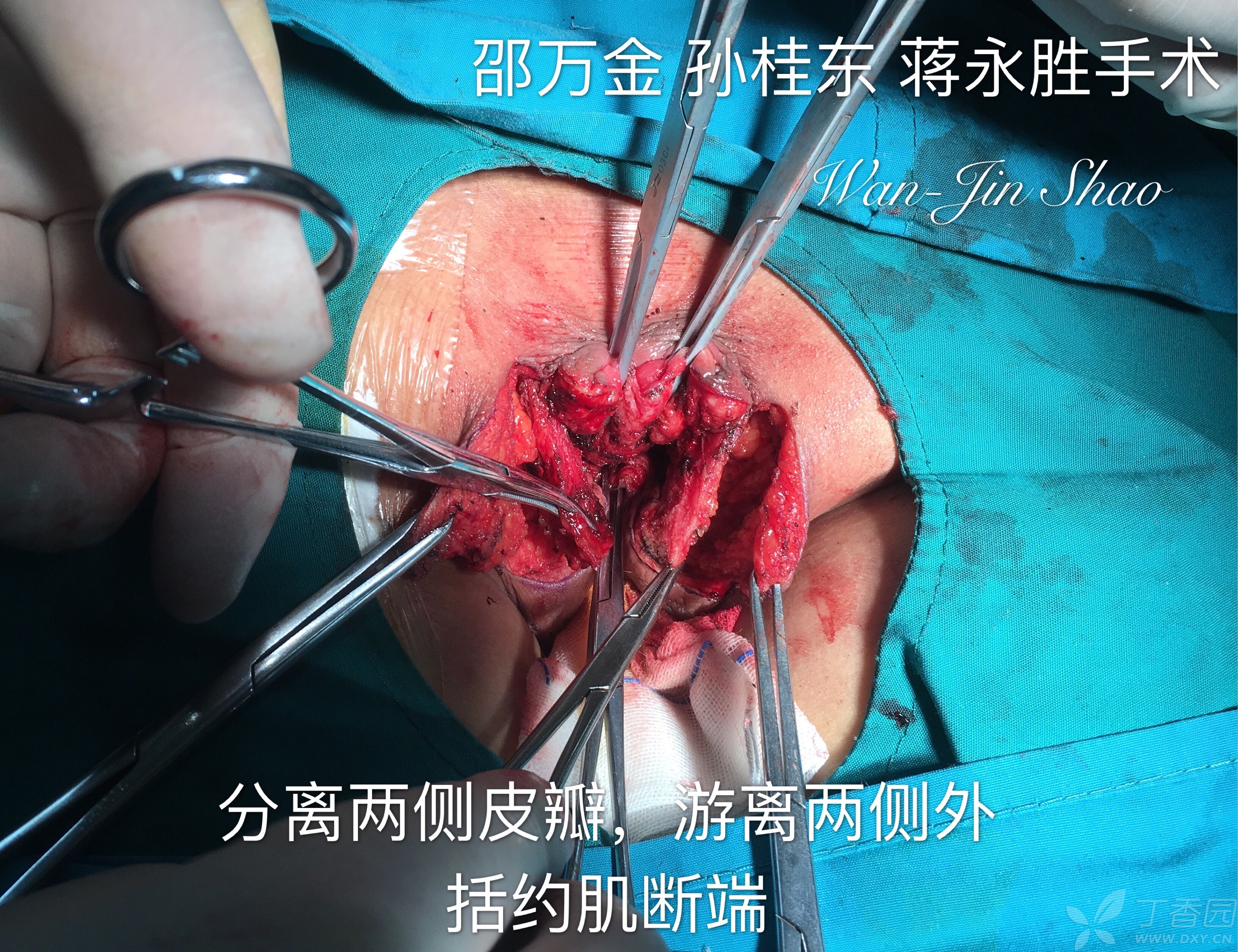 哨兵痔手术肛门处有刀口吗_哨兵痔手术 肛门失禁 怎么办_哨兵痔手术后好久能恢复