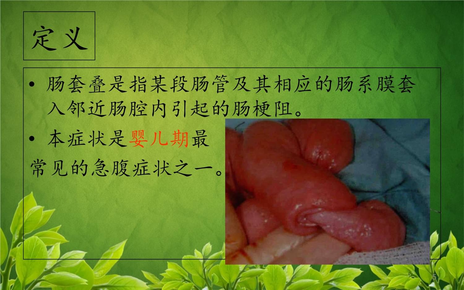 肠套叠ct描述模板_肠套叠的ct三大典型症状_肠套叠ct图