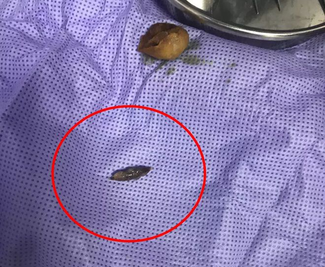 肛瘘手术多长时间能做爱_肛瘘手术多长时间能做爱_肛瘘手术多长时间能做爱