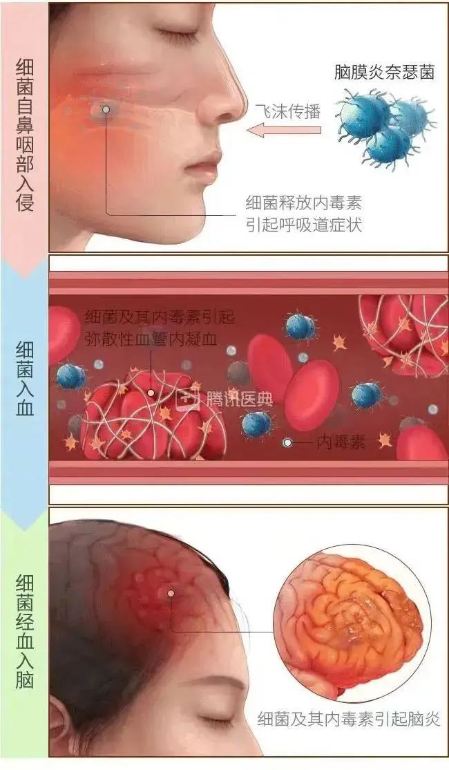 流脑传染性最强的阶段是_流脑主要传染对象_流脑传染源最具重要意义的是