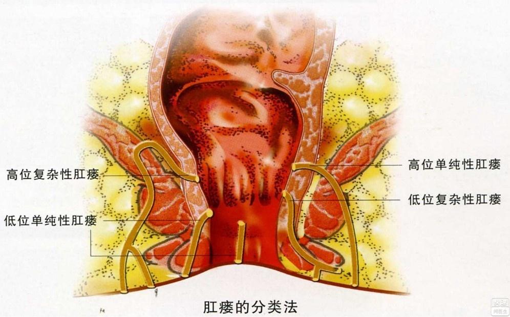 肛瘘多久做手术最好_肛瘘手术一般多长时间_多长手术一般肛瘘时间长啊